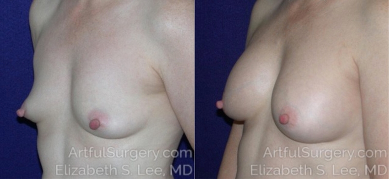 Picture of Breast Augmentation-21a