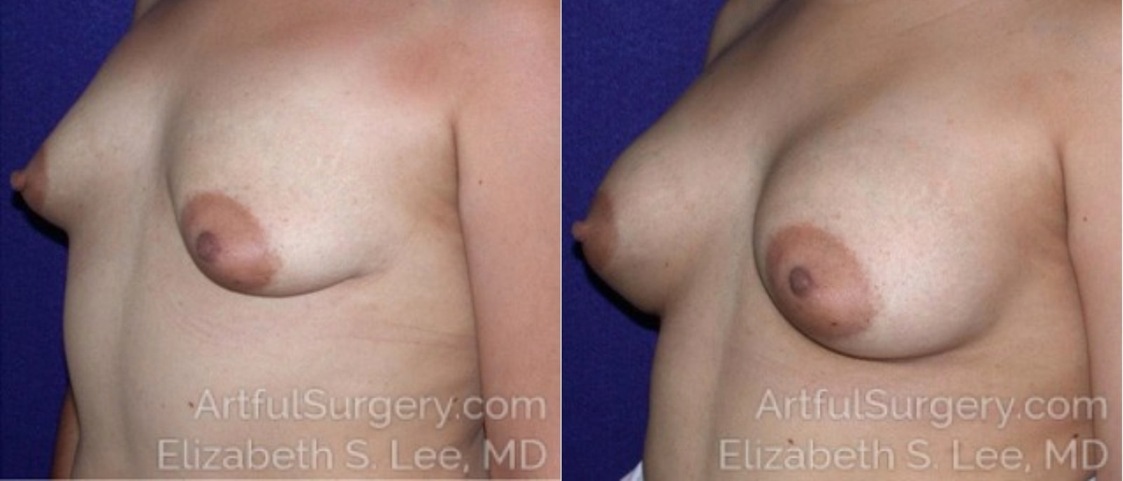 Picture of Breast Augmentation-22