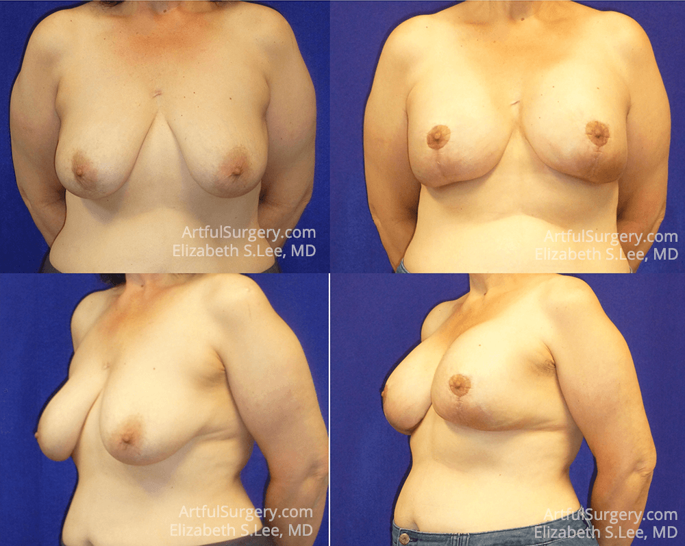 Picture of Breast Augmentation-24