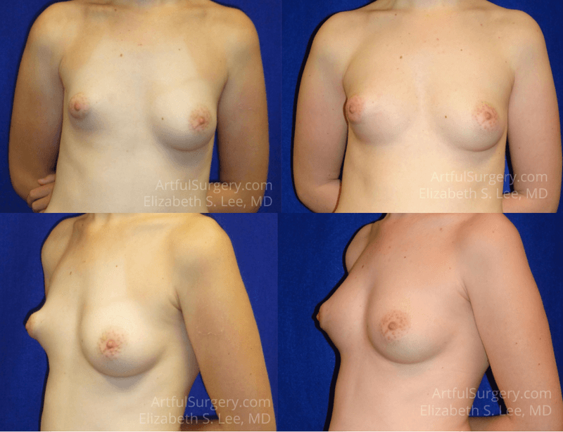 Picture of Breast Augmentation-26