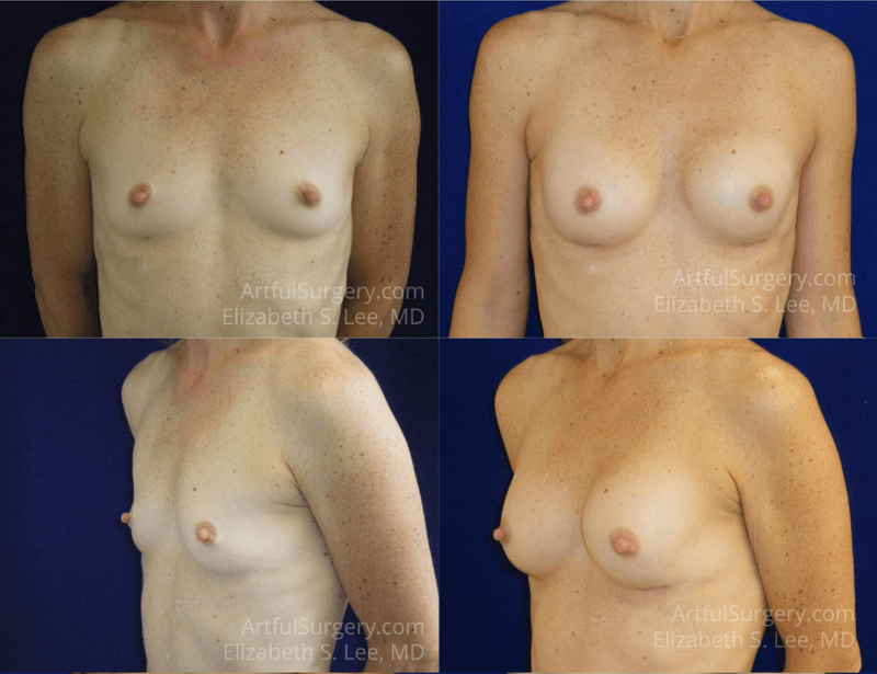 Picture of Breast Augmentation-29