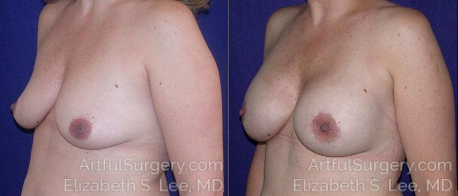 Picture of Breast Augmentation-3a