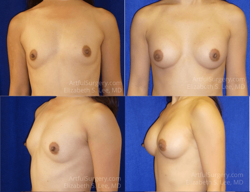 Picture of Breast Augmentation-30