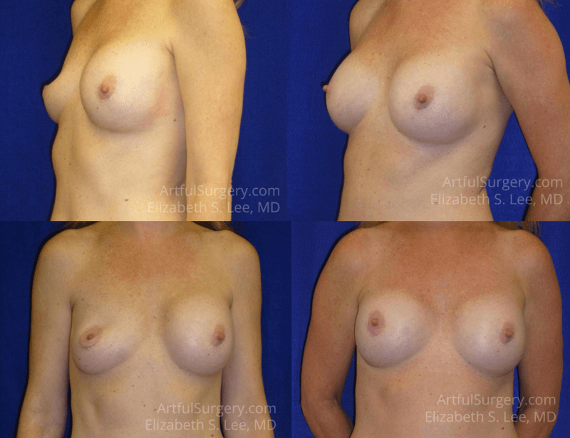 Picture of Breast Augmentation-31