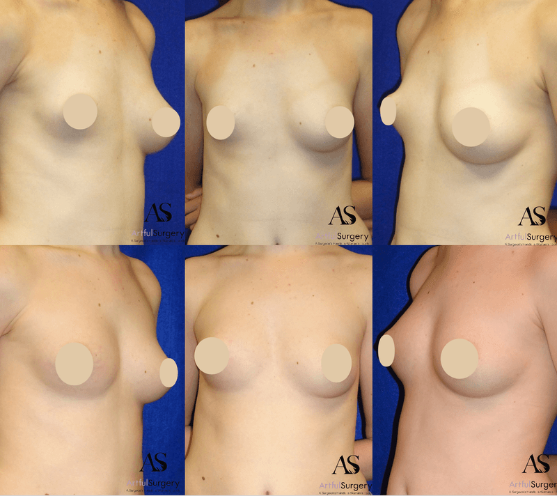 Picture of Breast Augmentation-33