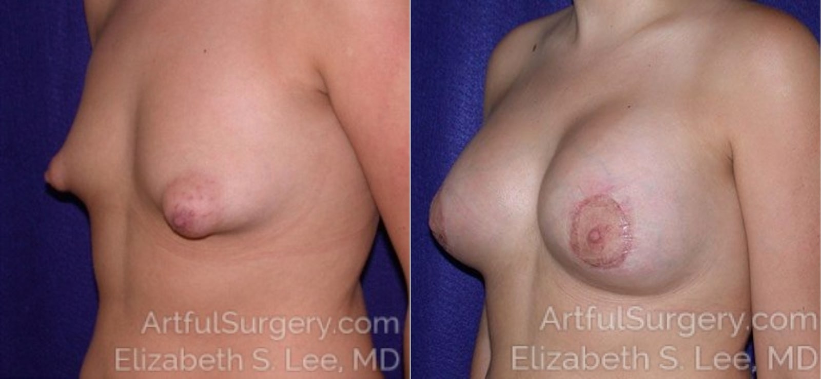 Picture of Breast Augmentation-3a