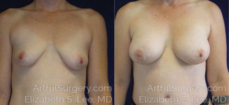 Picture of Breast Augmentation-4a