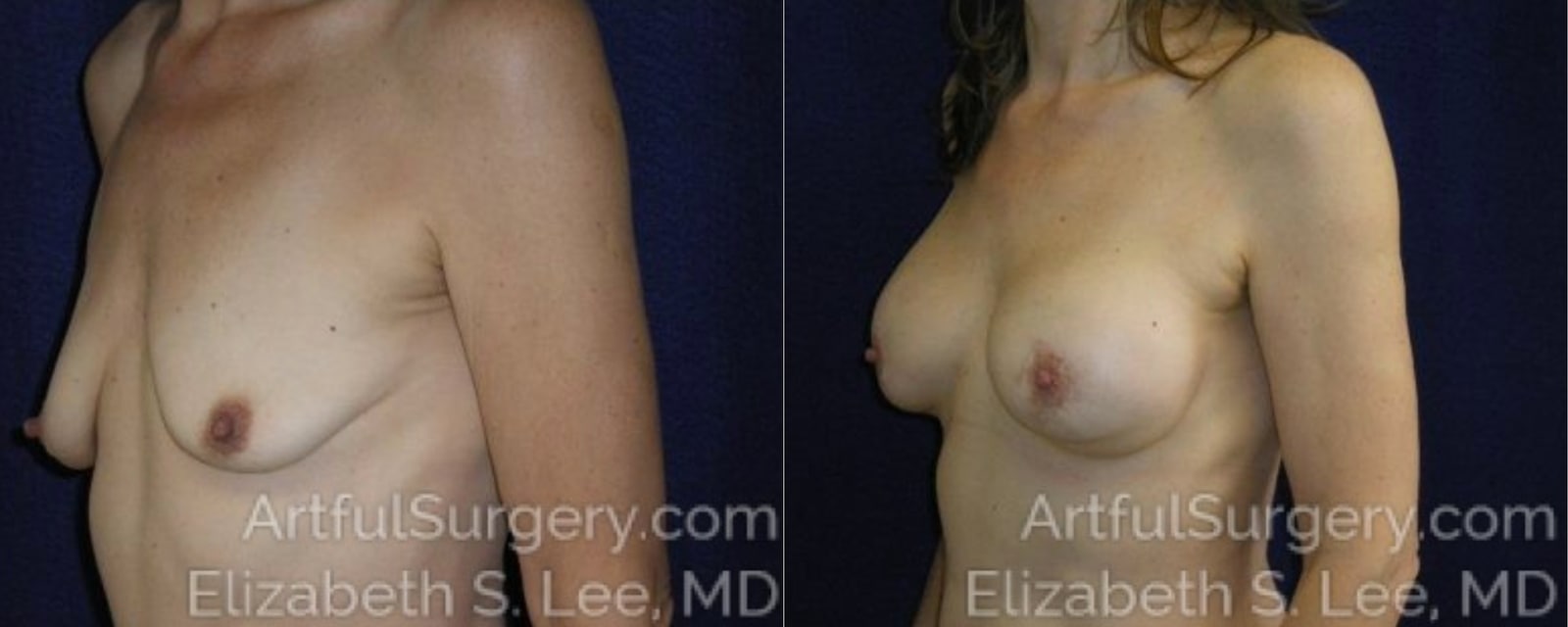 Picture of Breast Augmentation-5a