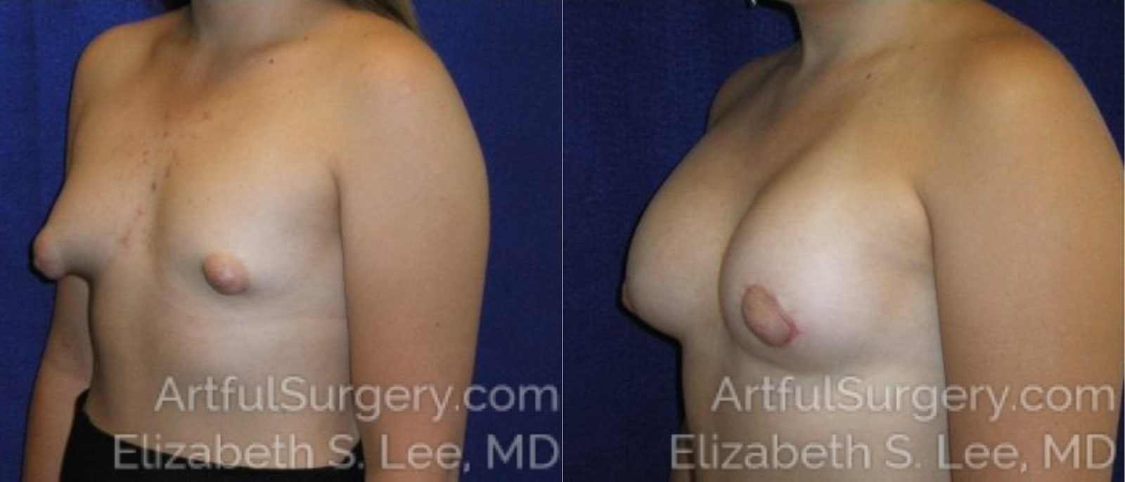 Picture of Breast Augmentation-6a