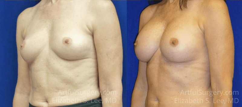 Picture of Breast Augmentation-8a