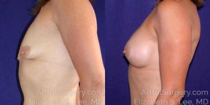 Picture of Breast Augmentation-8a