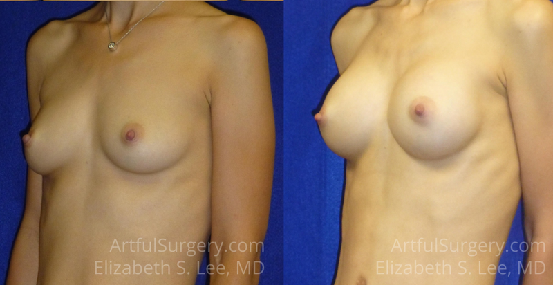 Picture of Breast Augmentation-9a