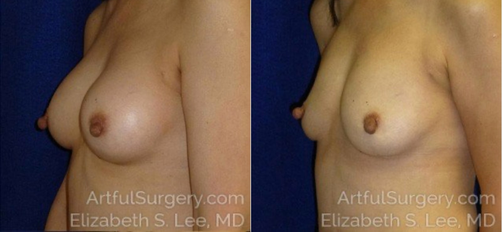 Picture of Breast Implant Removal-10a