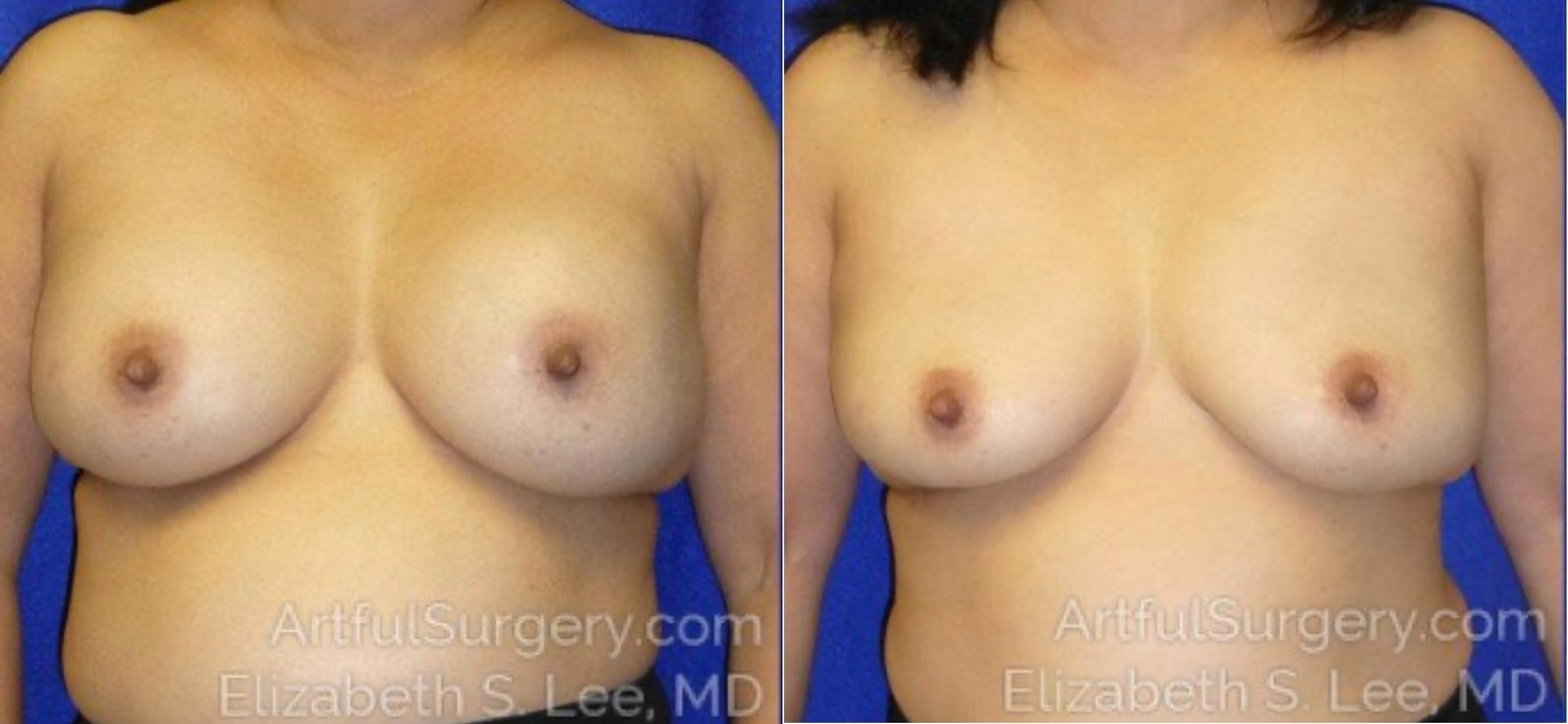 Picture of Breast Implant Removal-11