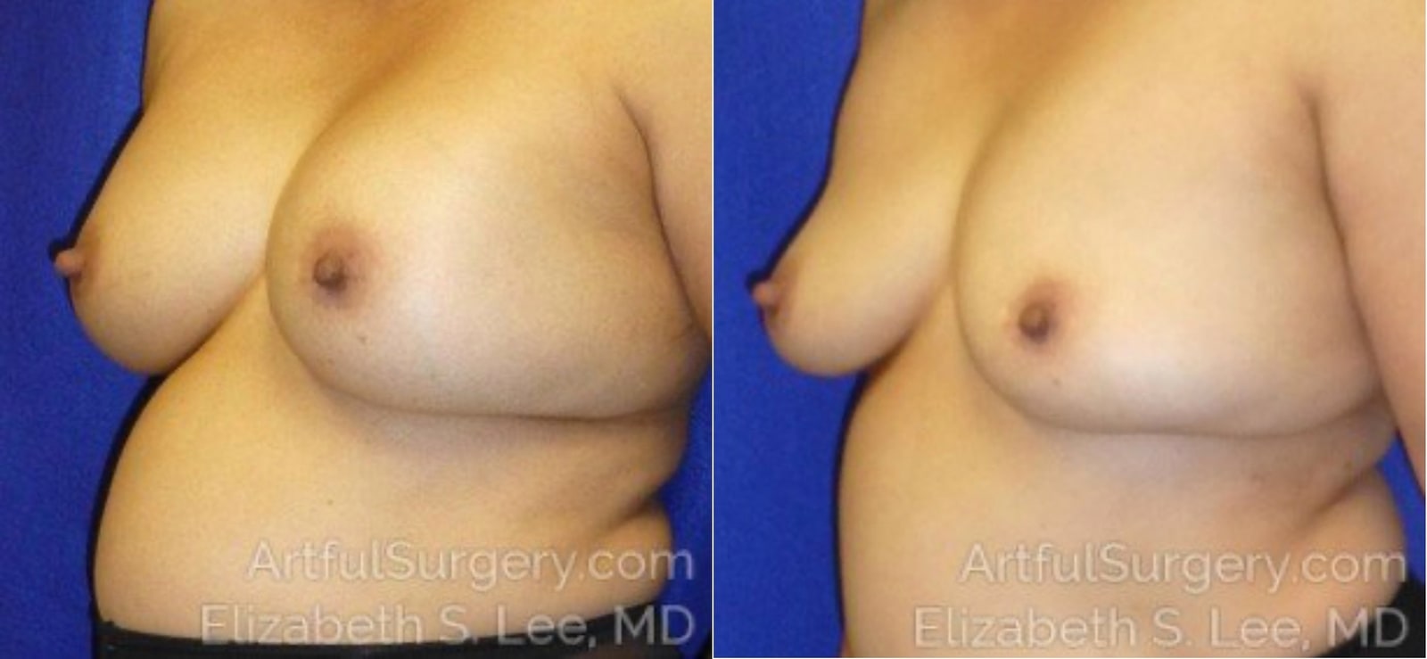 Picture of Breast Implant Removal-11a