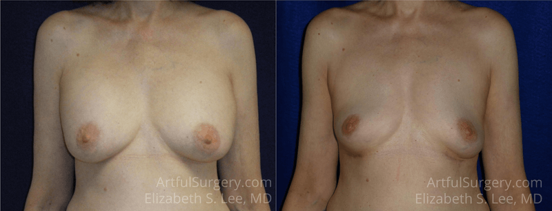 Picture of Breast Implant Removal-12