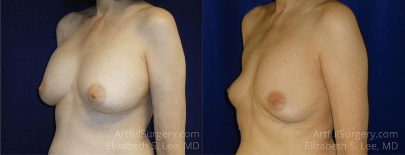 Picture of Breast Implant Removal-12a