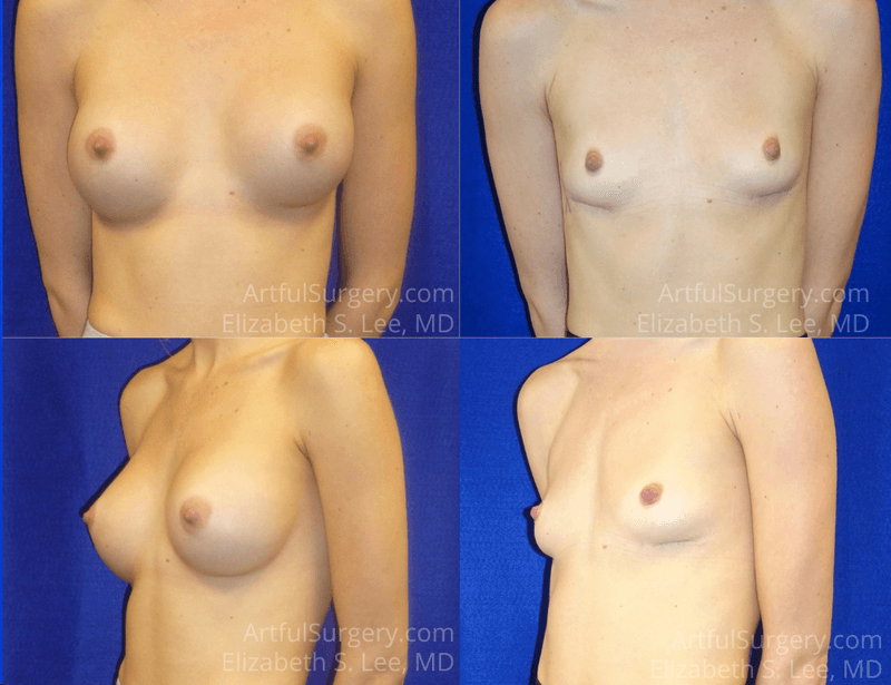Picture of Breast Implant Removal-13