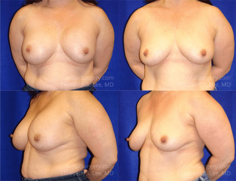 Picture of Breast Implant Removal-15