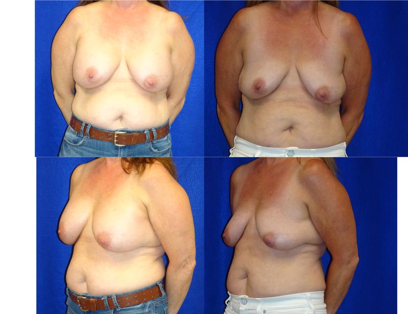 Picture of Breast Implant Removal-16