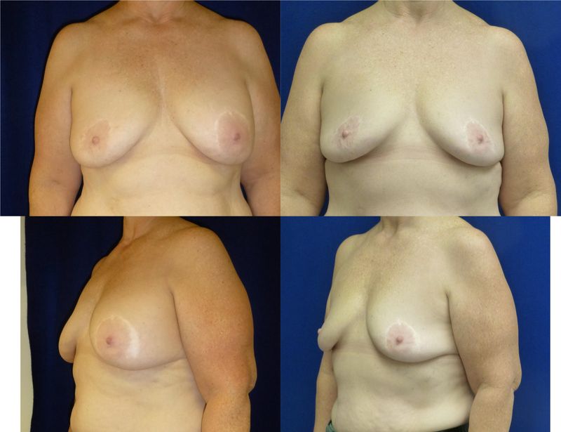 Picture of Breast Implant Removal-17