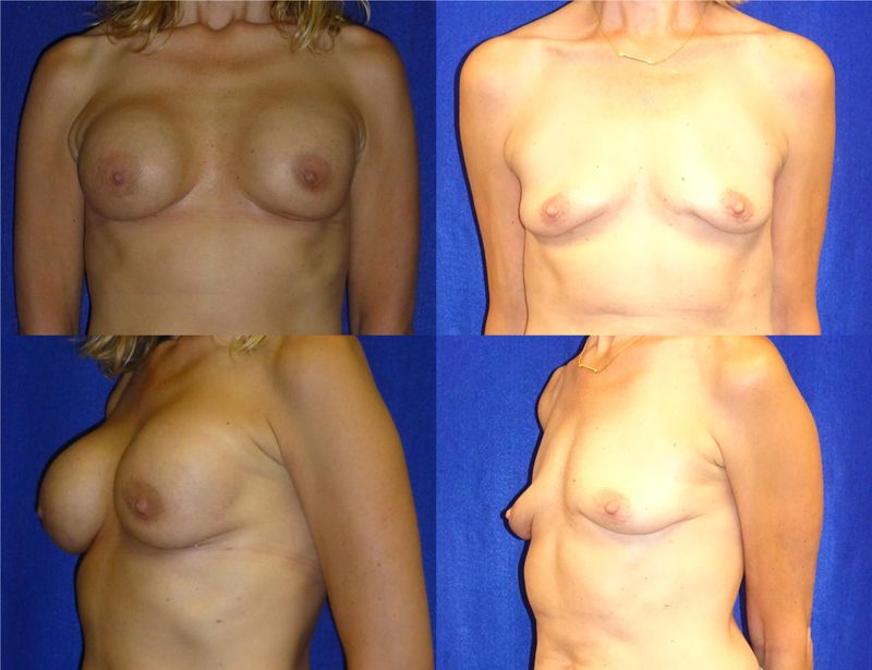 Picture of Breast Implant Removal-18