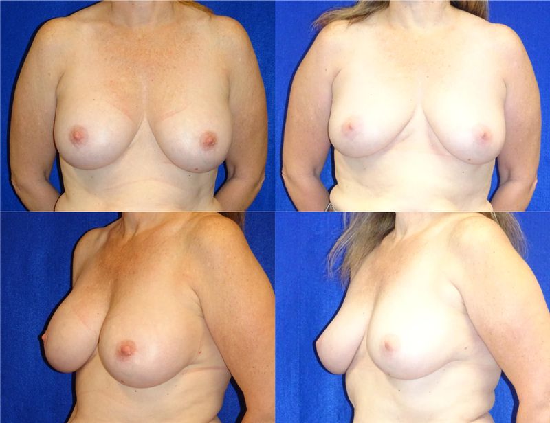 Picture of Breast Implant Removal-19