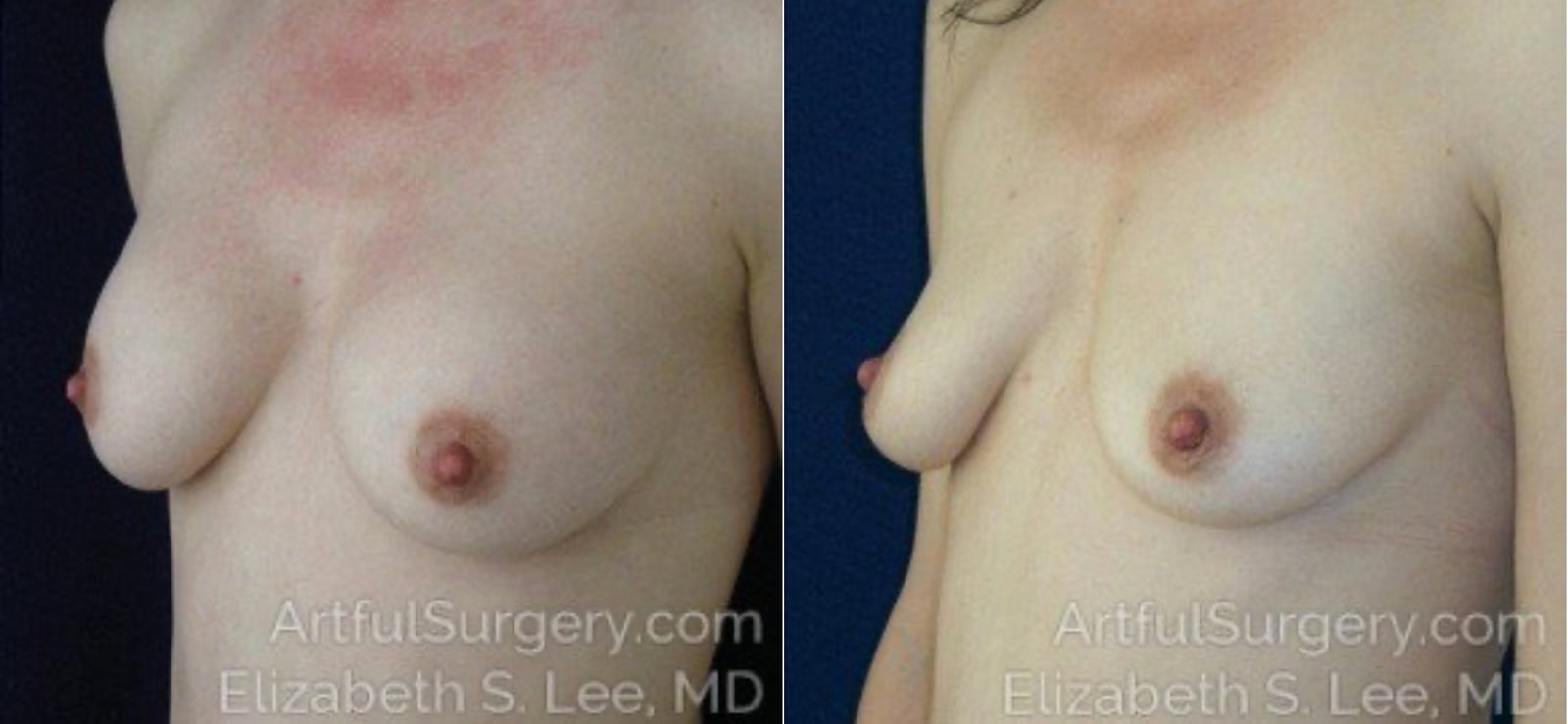 Picture of Breast Implant Removal-1a