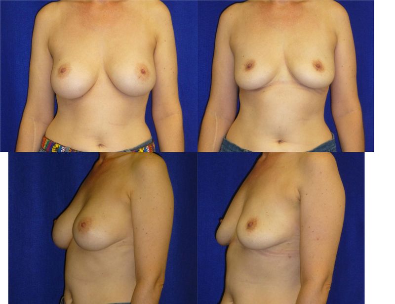 Picture of Breast Implant Removal-20