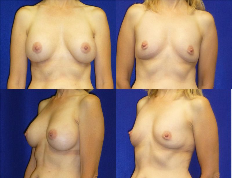 Picture of Breast Implant Removal-21