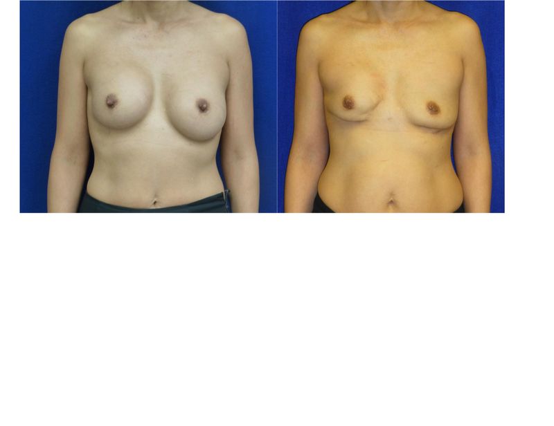 Picture of Breast Implant Removal-22