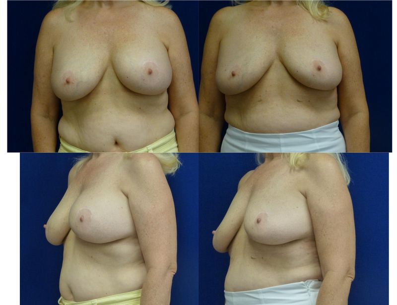 Picture of Breast Implant Removal-23