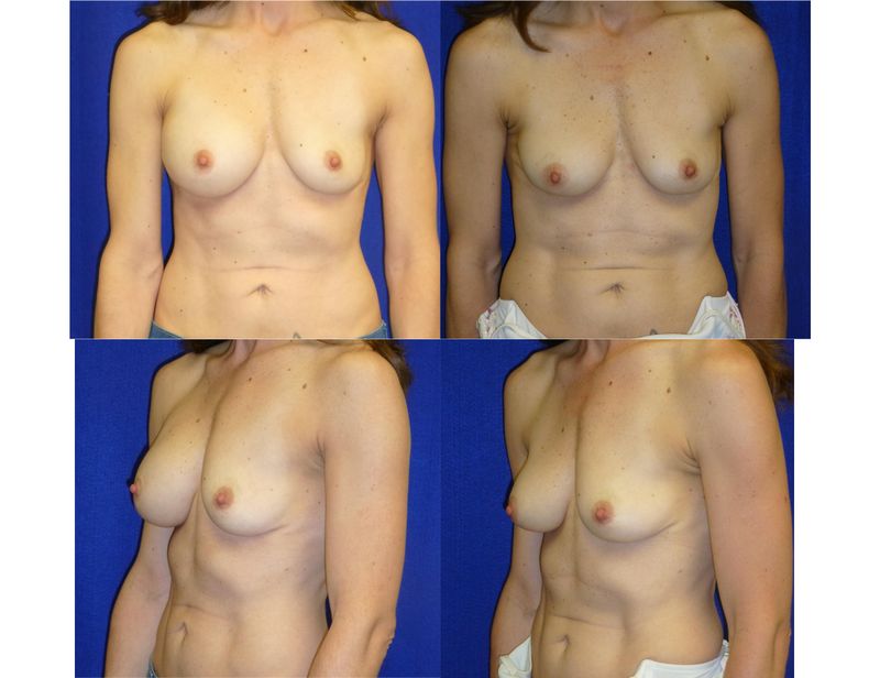 Picture of Breast Implant Removal-24