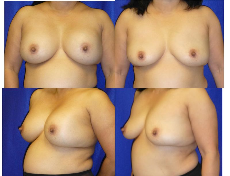 Picture of Breast Implant Removal-25