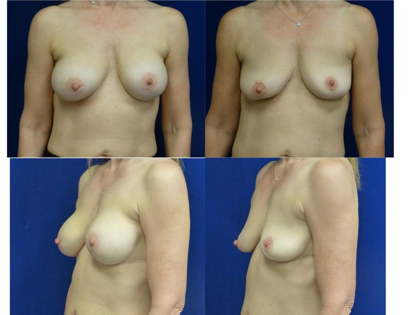 Picture of Breast Implant Removal-26