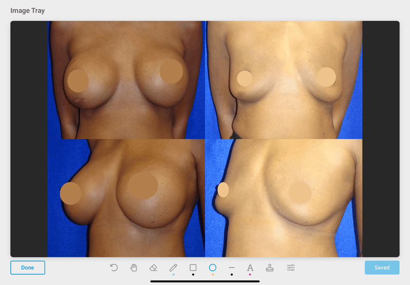 Picture of Breast Implant Removal-28