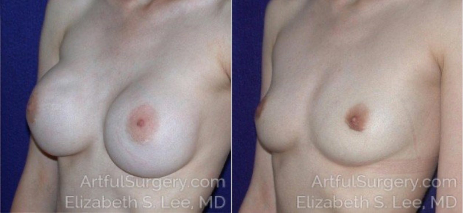 Picture of Breast Implant Removal-2a