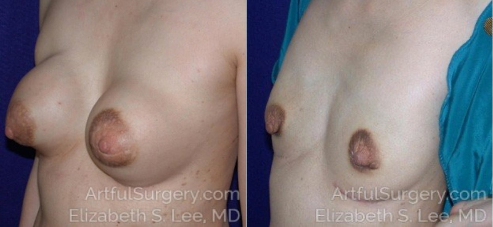 Picture of Breast Implant Removal-3a
