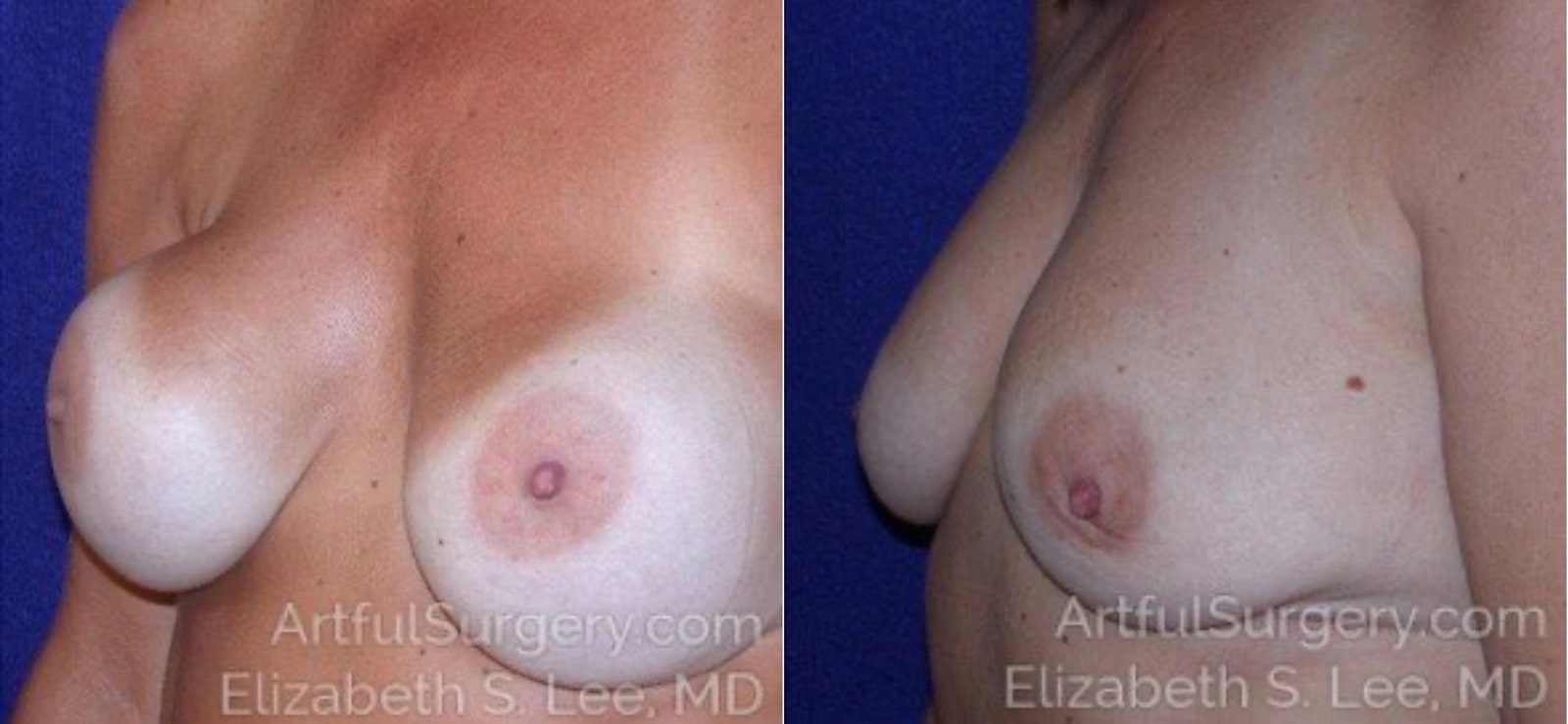 Picture of Breast Implant Removal-4a