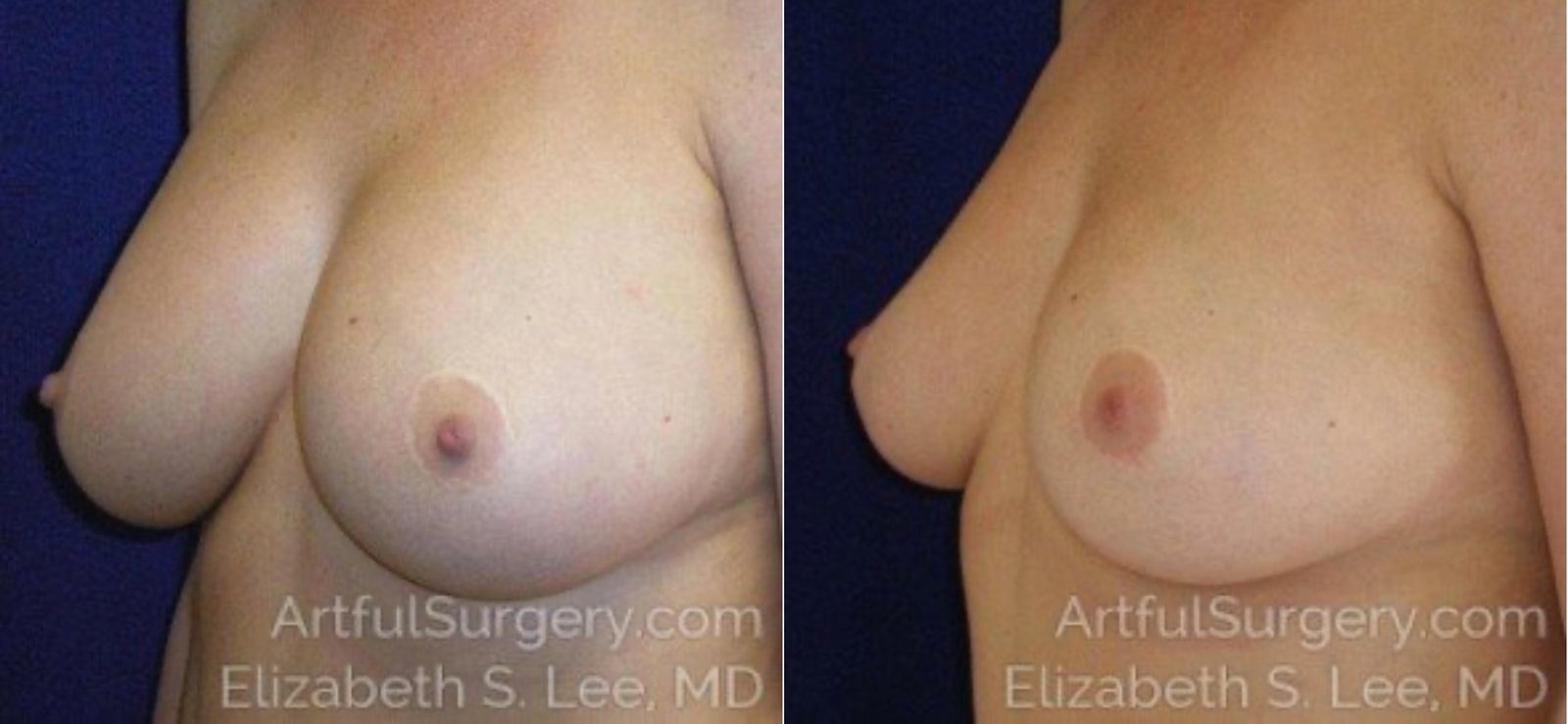 Picture of Breast Implant Removal-5a