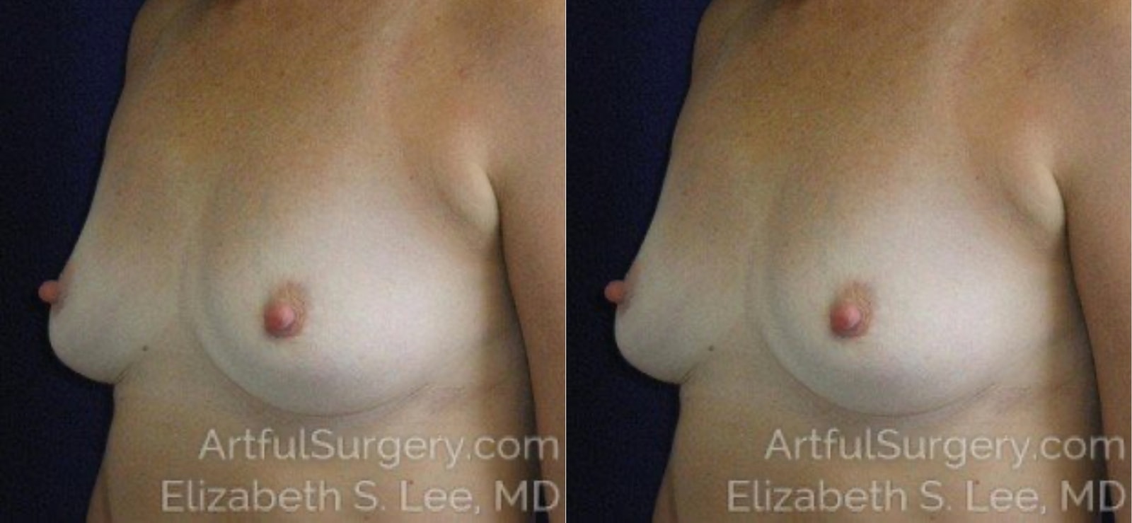 Picture of Breast Implant Removal-6a