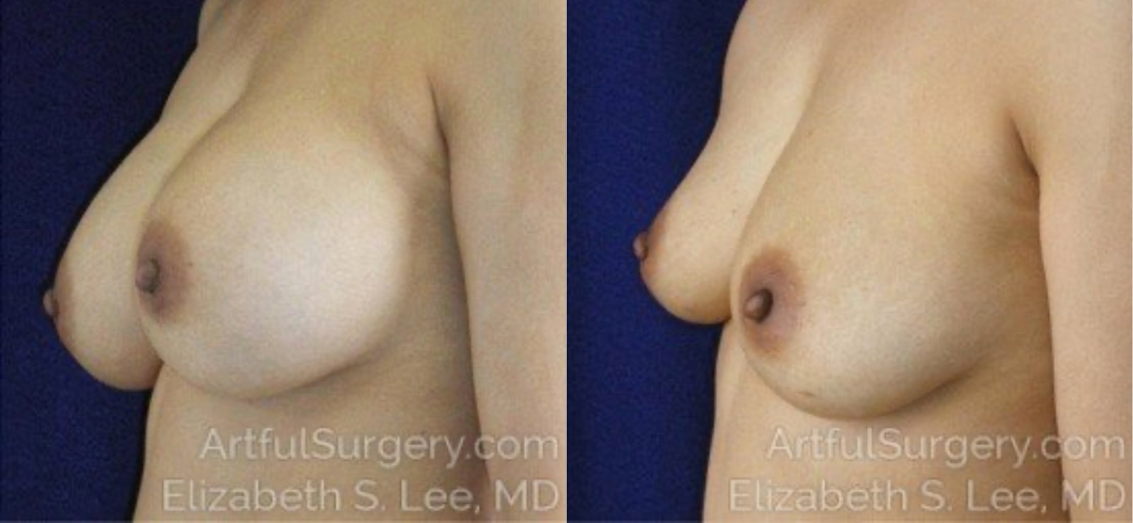 Picture of Breast Implant Removal-7a
