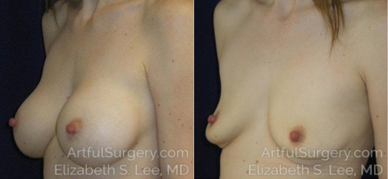 Picture of Breast Implant Removal-8a