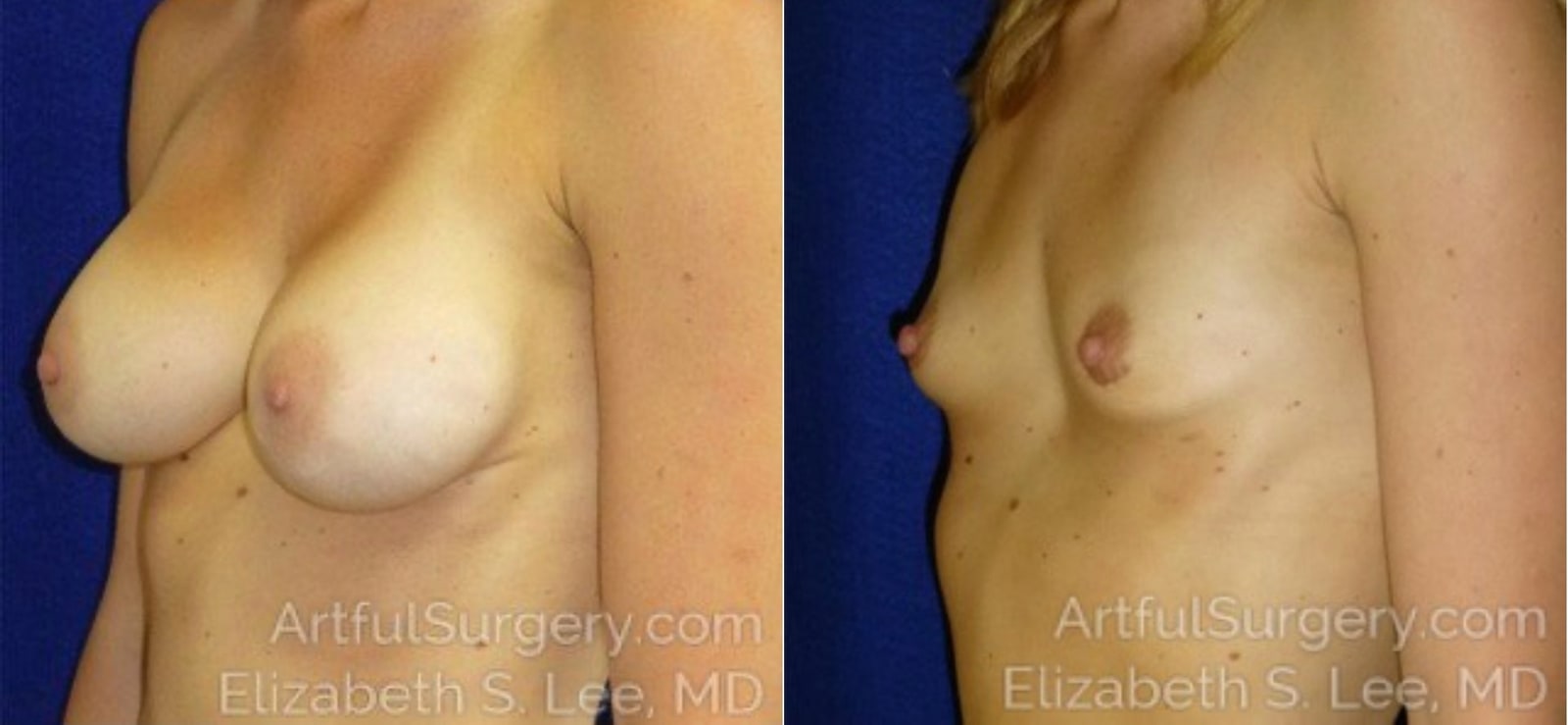 Picture of Breast Implant Removal-9a