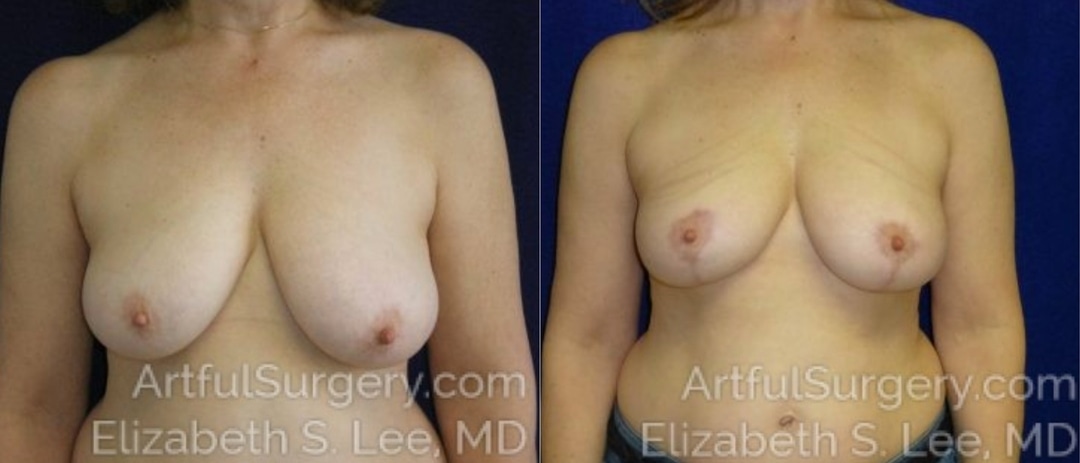 Picture of Breast Lift-1