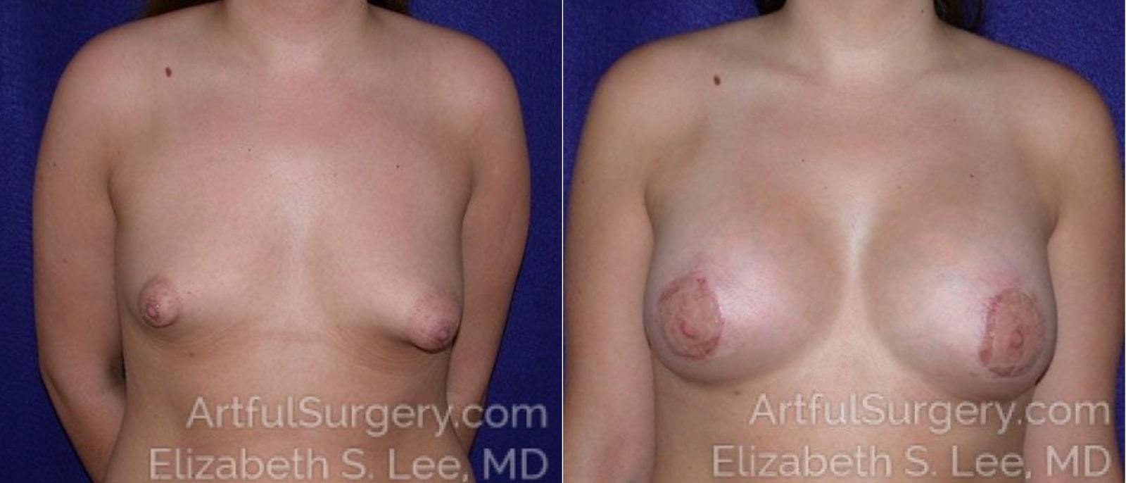 Picture of Breast Lift-10