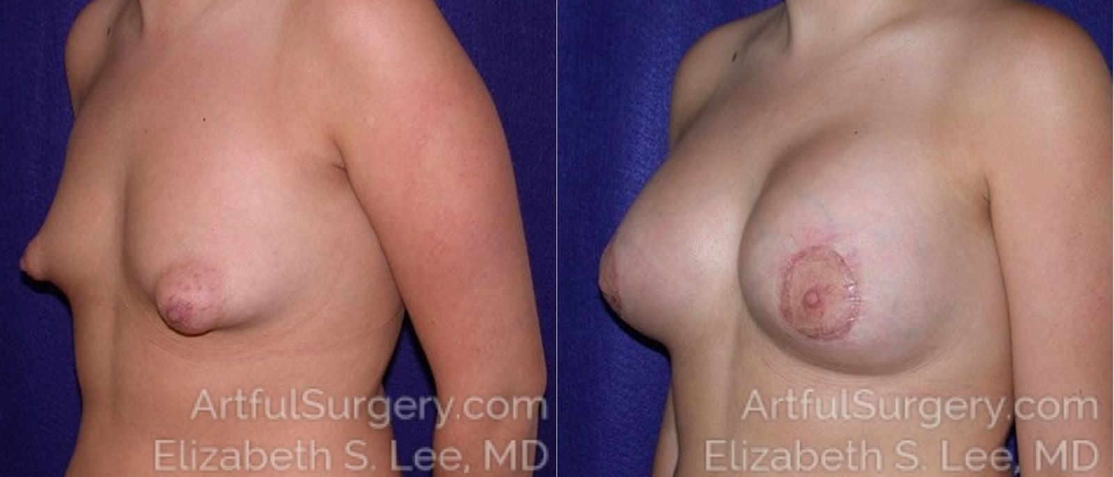 Picture of Breast Lift-10a