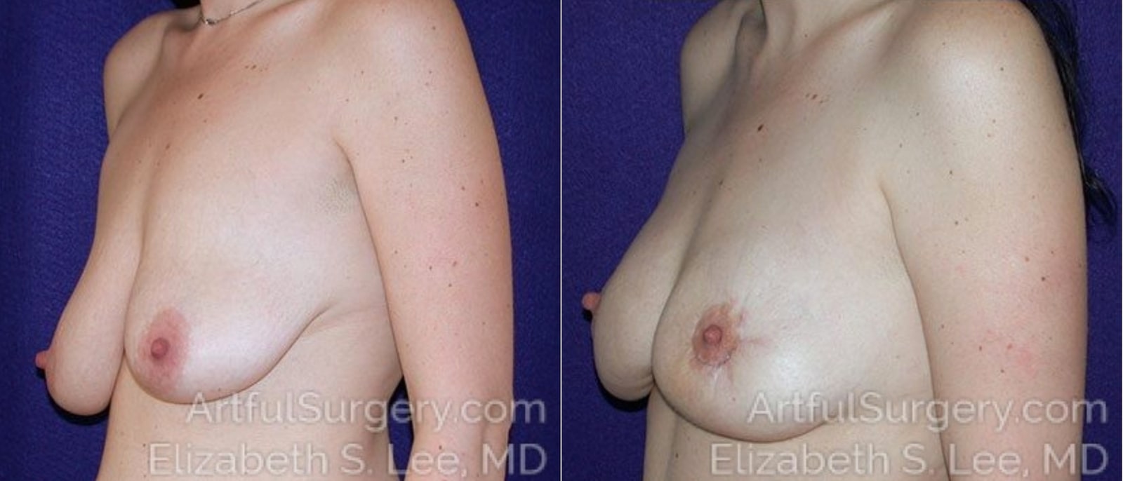 Picture of Breast Lift-11a