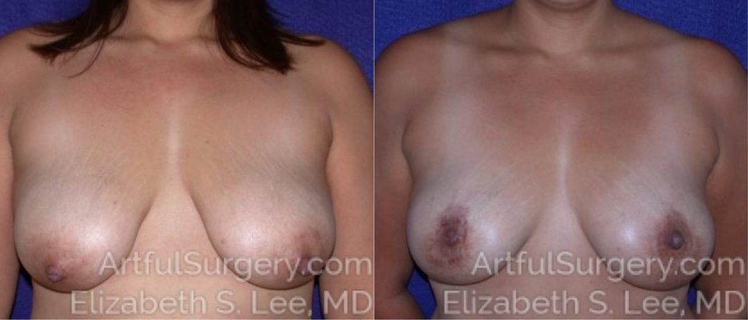 Picture of Breast Lift-13