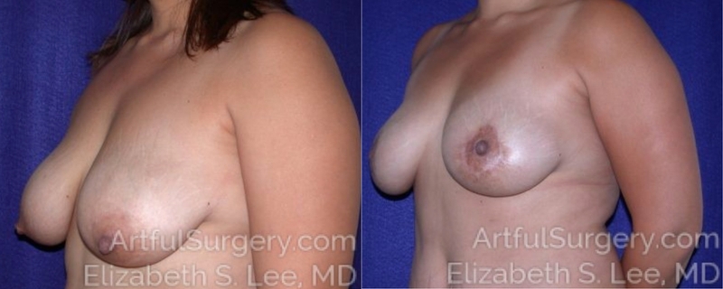 Picture of Breast Lift-13a